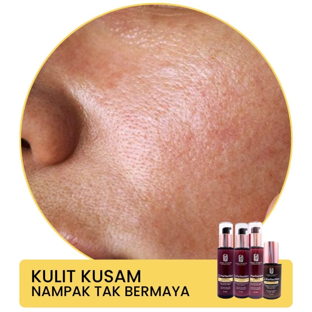 Kulit kusam Asma Harun