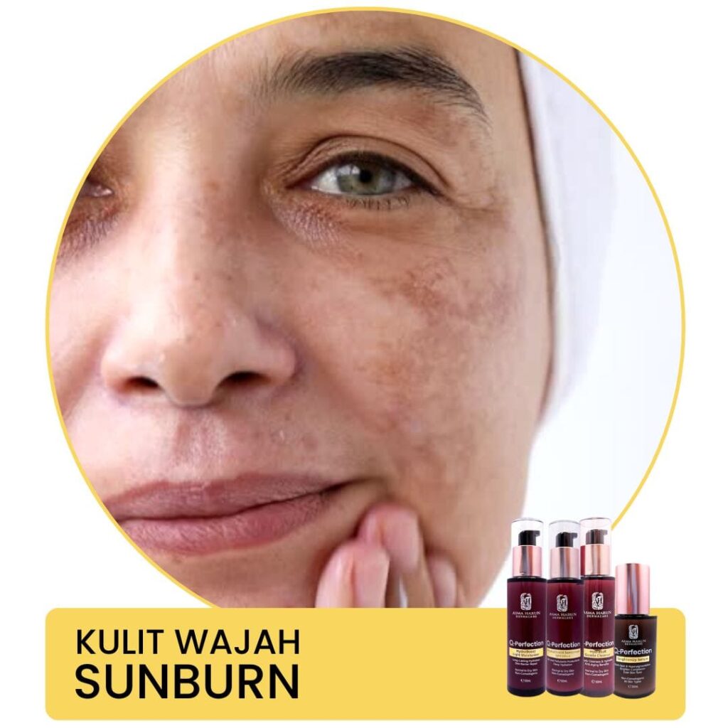Sunburn Asma Harun
