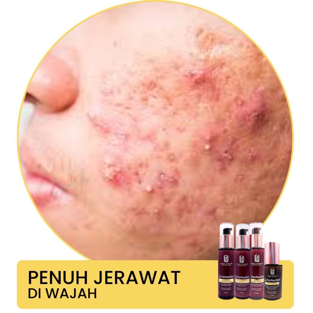 Penuh Jerawat Asma Harun