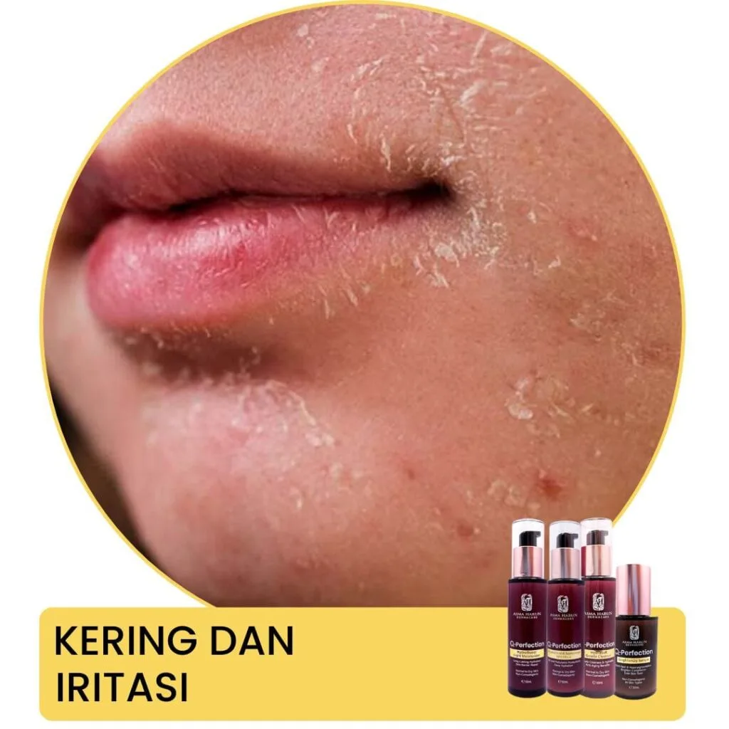Kering dan iritasi Asma Harun